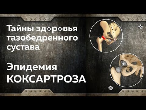 Артроз тазобедренного сустава. Коксартроз. Боль в бедре. Профилактика и лечение.